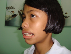 Opération de la petite Kanjana au Bangkok Hospital en Mai 2010